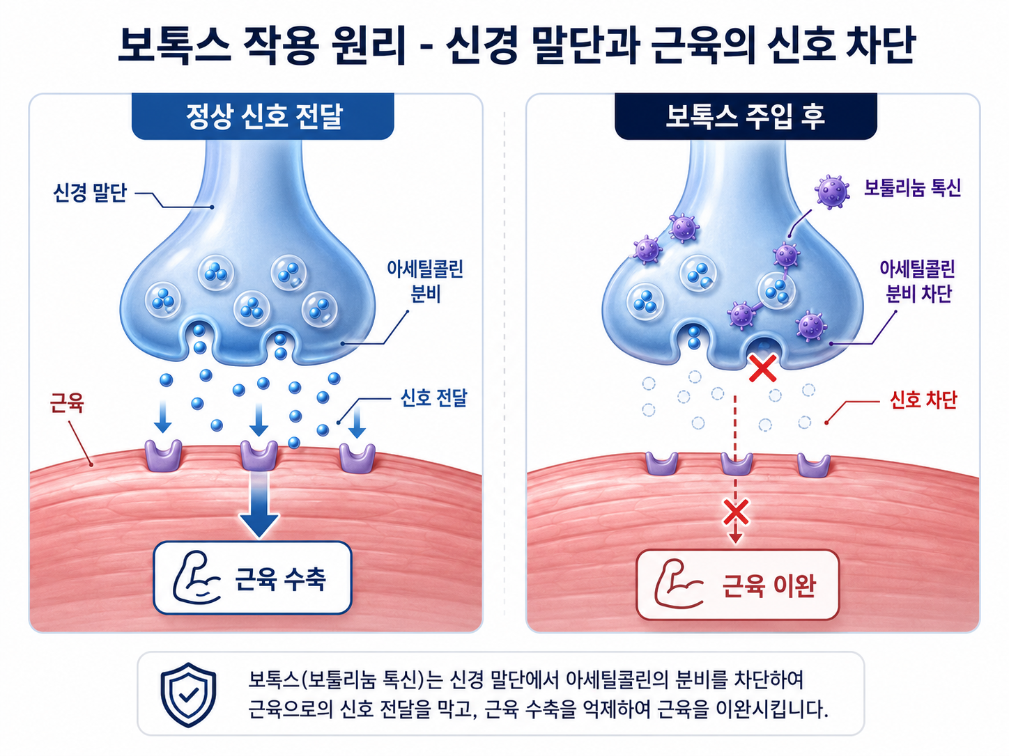보톡스 작용원리