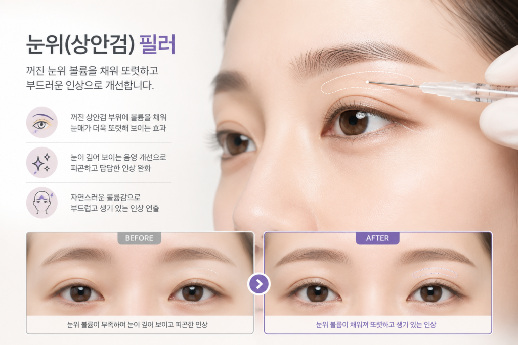 눈위필러 전 후 예시 사진